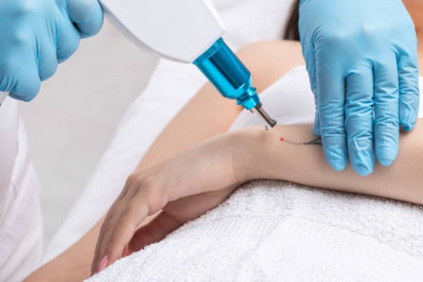 The doctor makes the procedure for laser tattoo removal on the girl's arm.